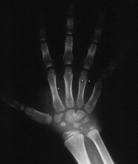 Raio-X de mão, mostrando a fusão de dois ossos (capitato e hamato), ponto comum entre as quatro doenças causadas pelo gene descoberto