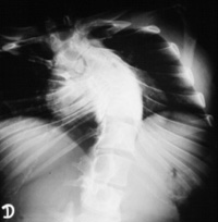 Raio-X de tórax, mostrando a fusão das vértebras, que causam importante desvio da coluna e achatamento da caixa torácica